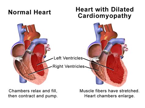 lv dilatation definition|does dilated cardiomyopathy go away.